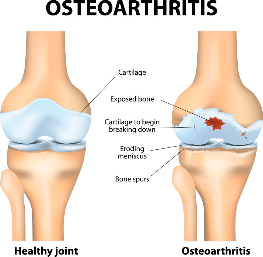 Osteoarthritis