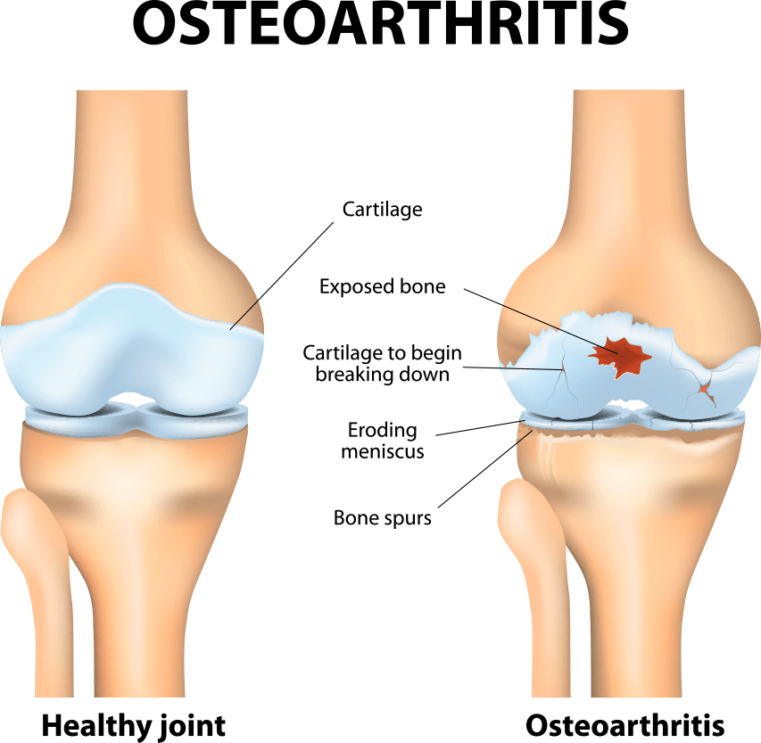 Osteoarthritis Osteoarthritis Treatment Advance Rheumatology